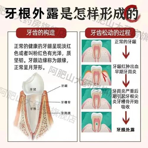 甲硝唑口腔粘贴片效果到底怎么样?