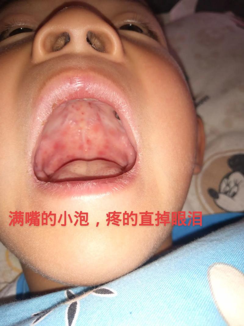 手足口病口腔图片有哪些典型症状？