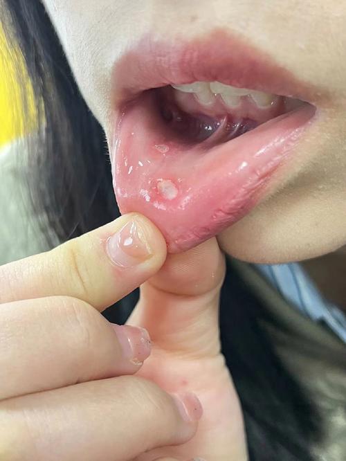 轻度口腔溃疡图片长啥样？