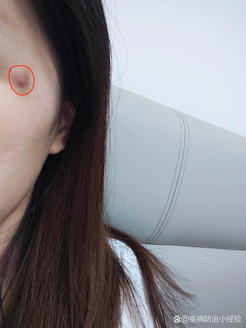 脸上皮下硬疙瘩是何原因？