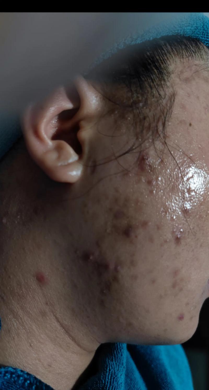 脸上皮下硬疙瘩是何原因?