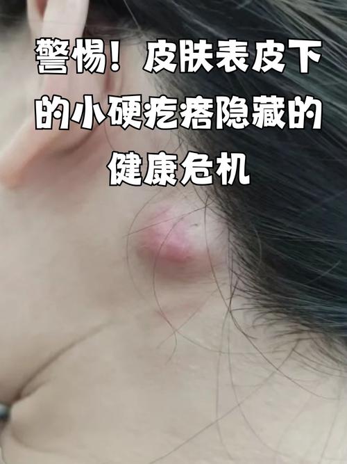 脸上皮下硬疙瘩是何原因?