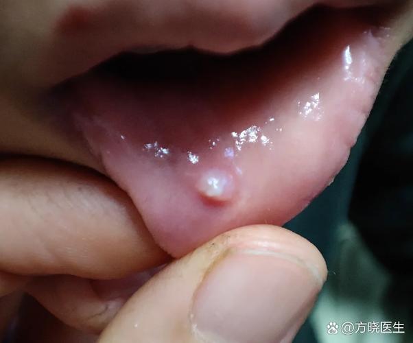 口腔内壁小肉疙瘩疼是啥原因？