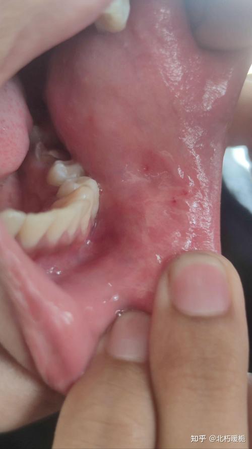 口腔内壁小肉疙瘩疼是啥原因?