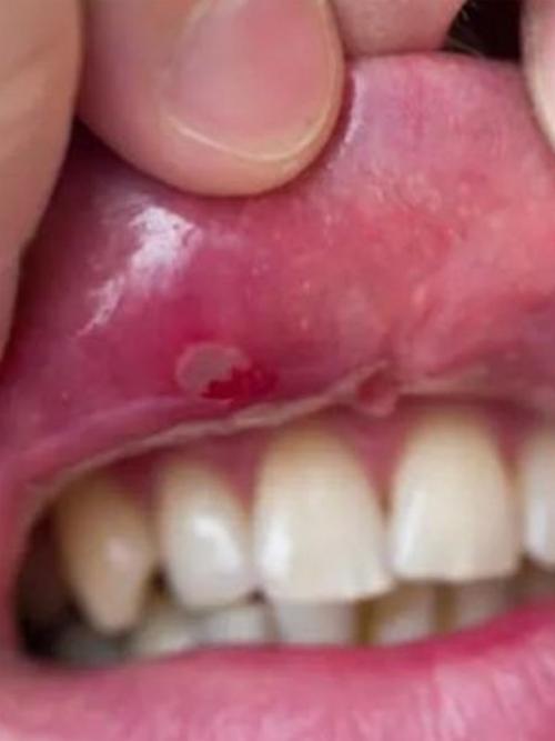 口腔内壁小肉疙瘩疼是啥原因?