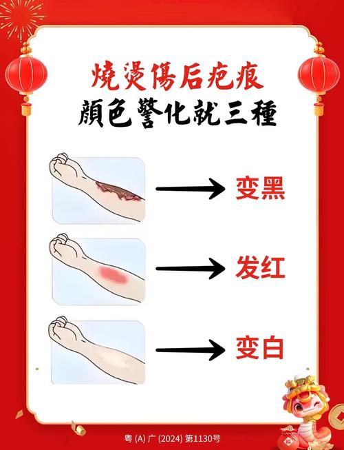 火烤伤皮肤后该如何紧急处理?