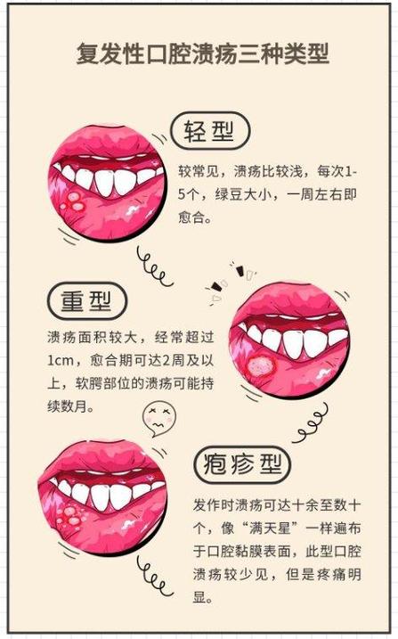 口腔溃疡位置真能对应病情?