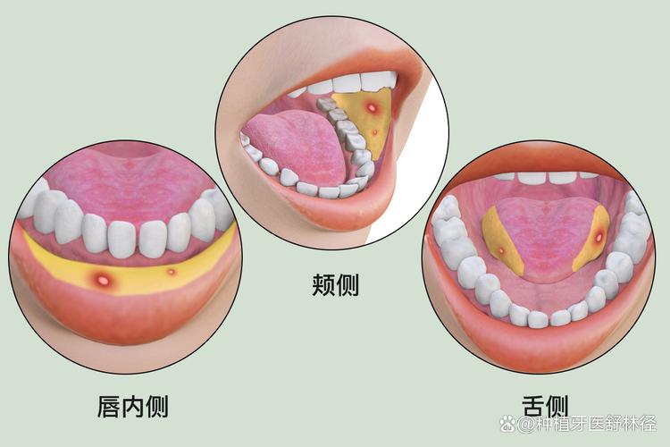 口腔溃疡位置真能对应病情？