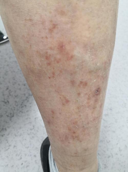 小腿鱼鳞样皮肤怎么治?