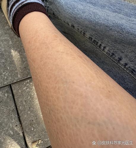 小腿鱼鳞样皮肤怎么治?