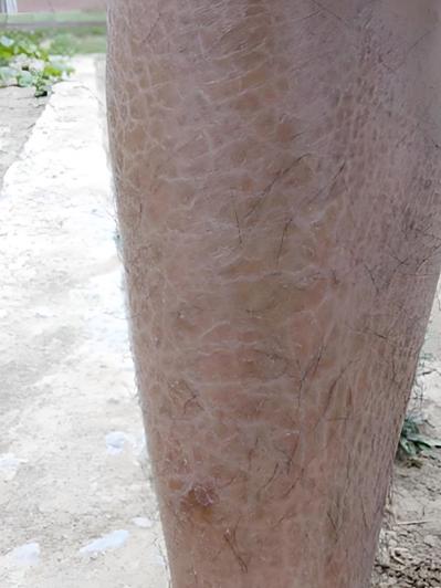 小腿鱼鳞样皮肤怎么治？