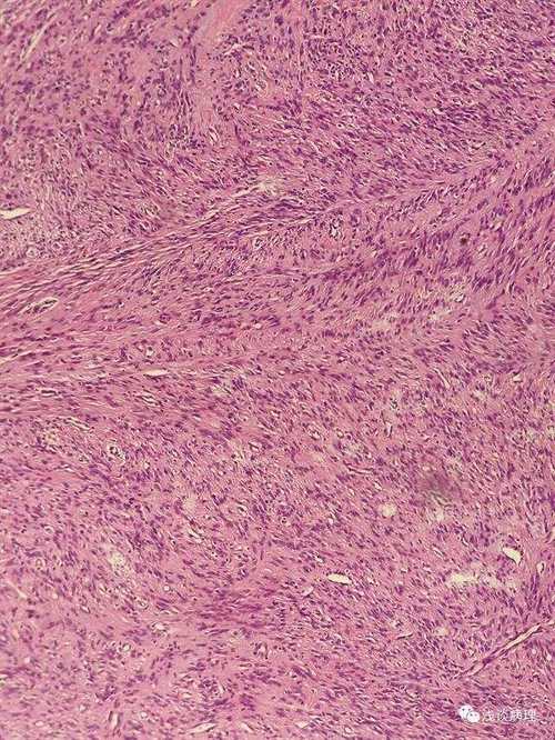 皮肤隆突纤维肉瘤图片长啥样？