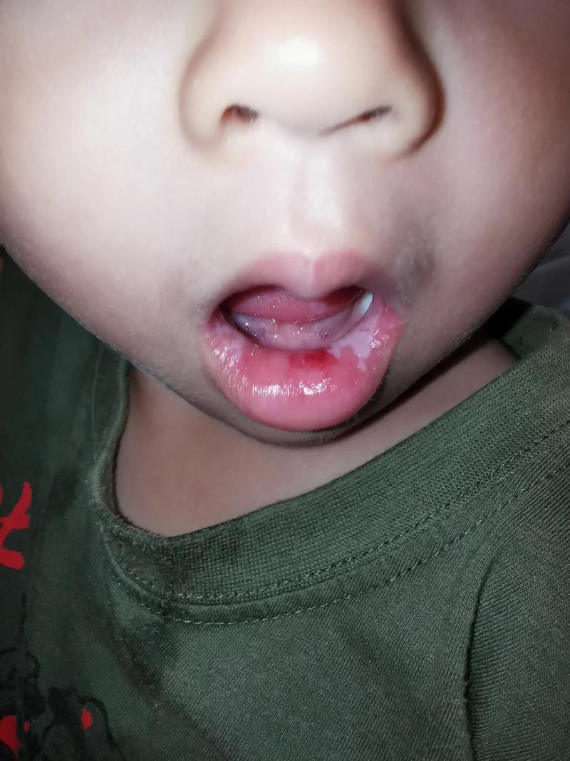 婴儿口腔溃疡图片怎么识别?