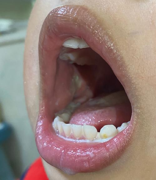 婴儿口腔溃疡图片怎么识别？