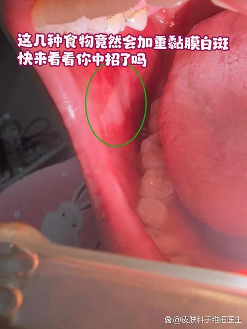 槟榔吃出口腔发白，是癌前病变信号吗？