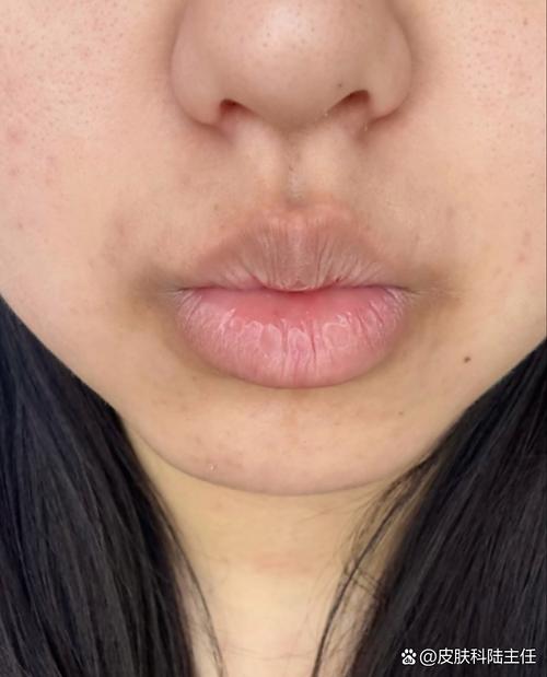 嘴唇周围为何暗沉发黑？
