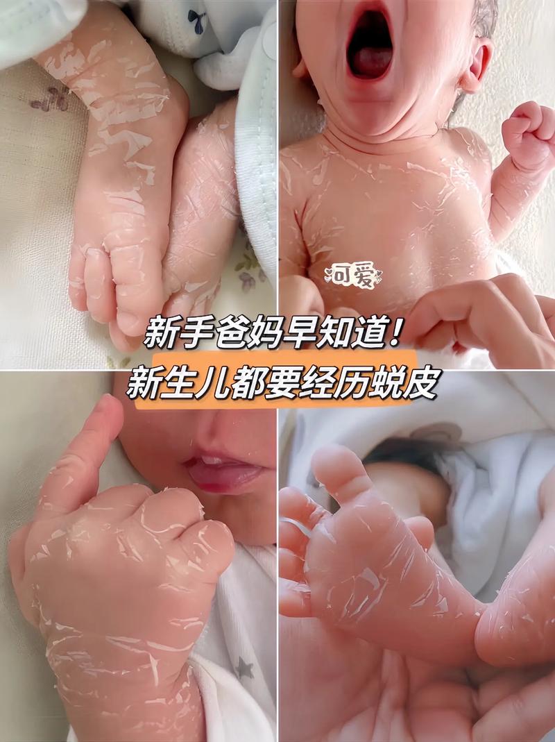 宝宝皮肤破皮了擦什么？