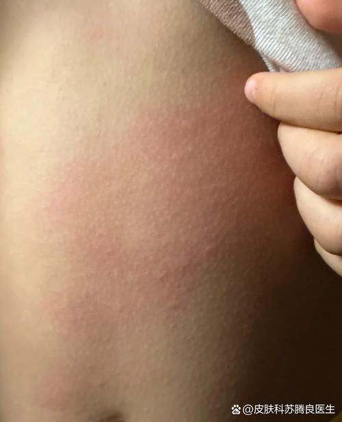 为何晚上皮肤瘙痒白天却没事？