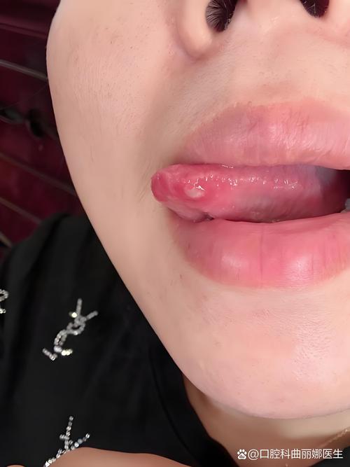 中度口腔溃疡图片长啥样？