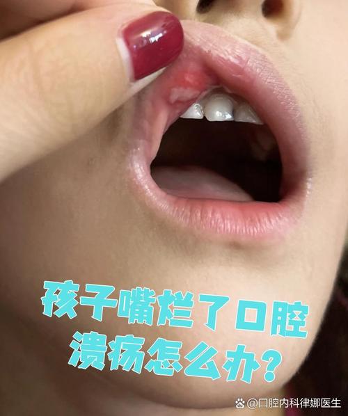 宝宝嘴唇破口腔溃疡怎么办？