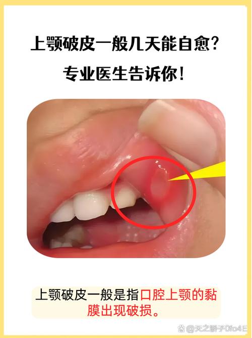 口腔上颚溃烂怎么治？