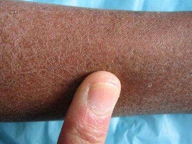 进行性特发性皮肤萎缩，病因究竟何在？