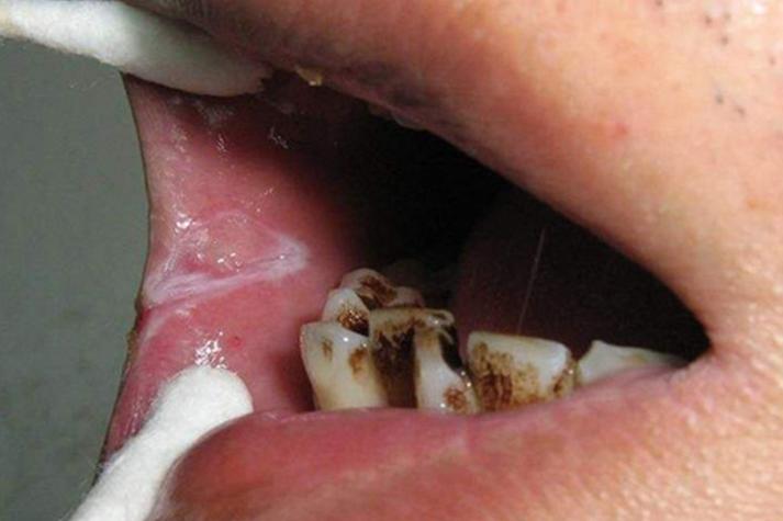 每天早上口腔黏膜脱落，是身体什么信号？