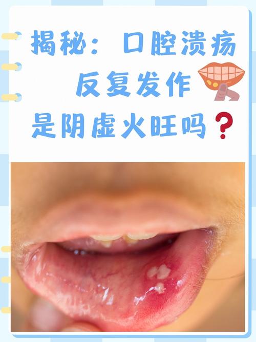 口腔内发热是何原因导致？