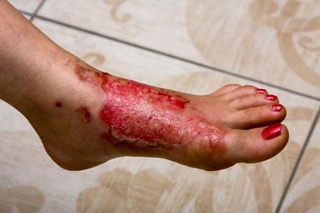 皮肤起红斑是何原因？需警惕哪些疾病？