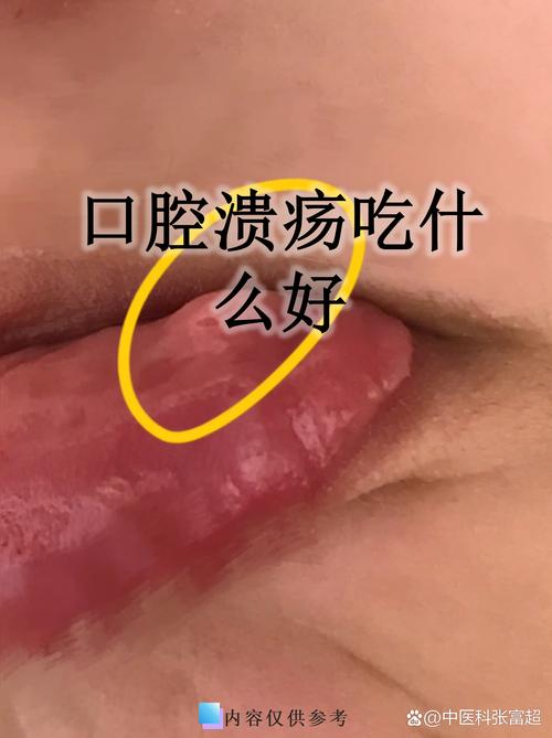 口腔缝针后吃什么食物好?