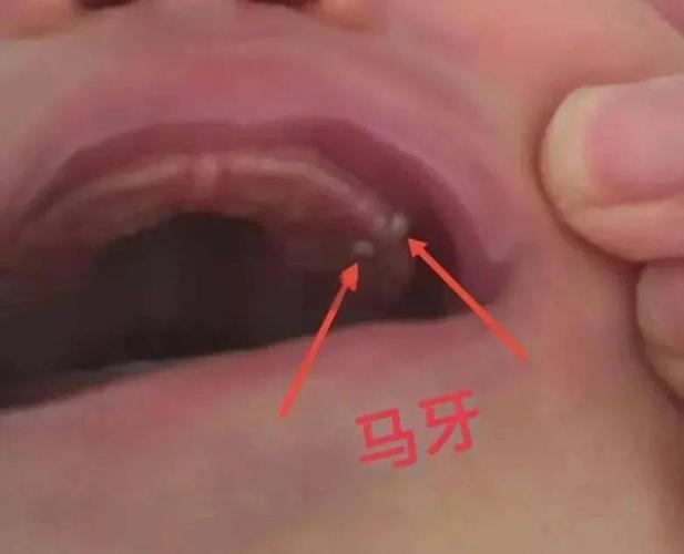 宝宝口腔长白点点是啥?图片咋辨别?