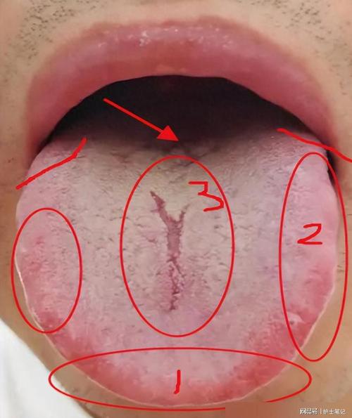 舌根长肉疙瘩是何原因?