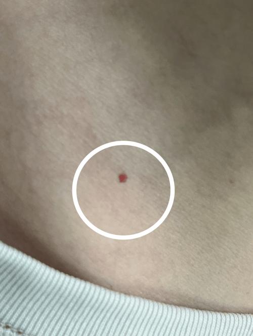 皮肤针尖小红血点是什么信号？