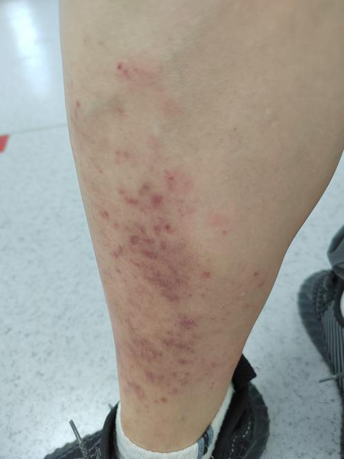 皮肤毛细血管扩张红斑是何因？