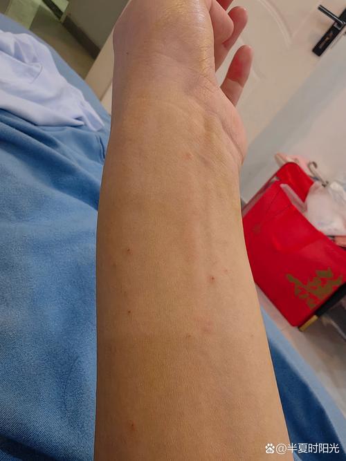 皮肤干燥痒起小红疙瘩怎么办?