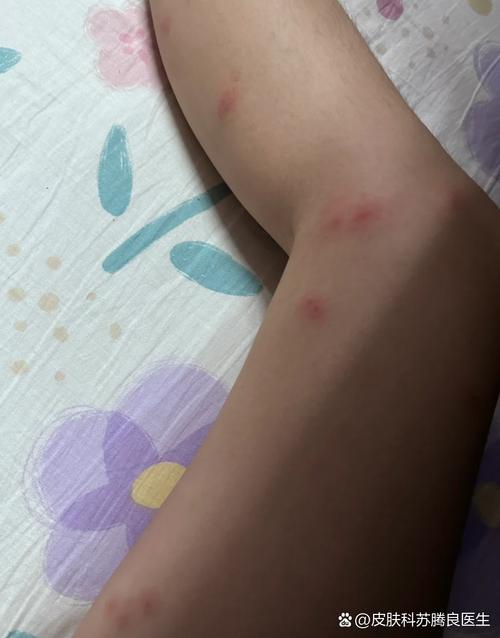 皮肤干燥痒起小红疙瘩怎么办?