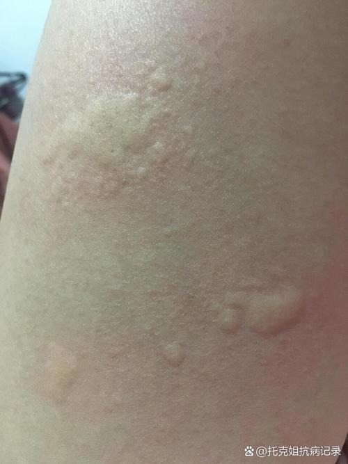 皮肤干燥痒起小红疙瘩怎么办？