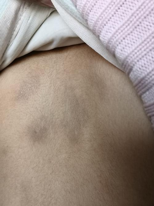 后背皮肤为何发黑粗糙?图片揭示什么问题?