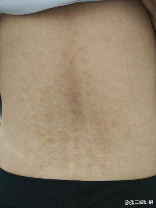 后背皮肤为何发黑粗糙?图片揭示什么问题?