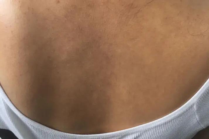 后背皮肤为何发黑粗糙?图片揭示什么问题?