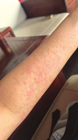 皮肤螨虫过敏图片有哪些症状表现?