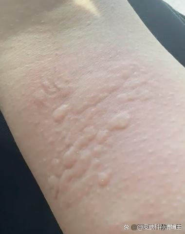 皮肤螨虫过敏图片有哪些症状表现?