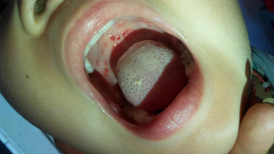 小孩口腔上颚血红点是何原因?