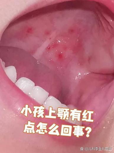 小孩口腔上颚血红点是何原因？