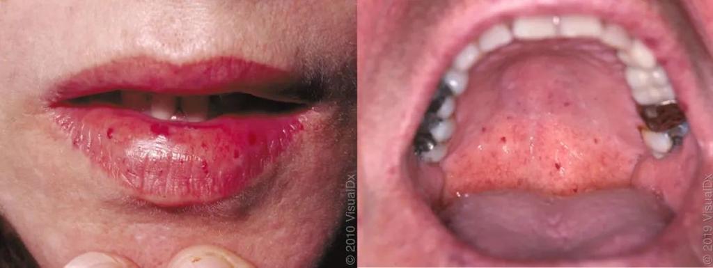 小孩口腔上颚血红点是何原因?