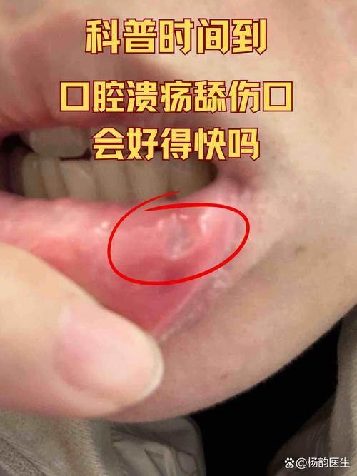 为何嘴巴咬到会变成口腔溃疡？