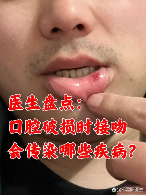 为何嘴巴咬到会变成口腔溃疡?