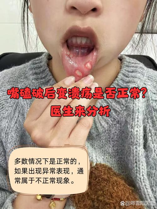 为何嘴巴咬到会变成口腔溃疡?