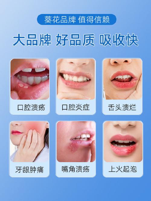 放疗后口腔溃烂,该用什么药缓解?