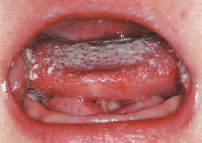 口腔铜绿假单胞菌感染有何危害与应对?